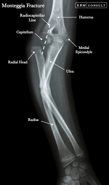 Monteggia Fracture Ulnar Fracture And Radial Head Dislocation